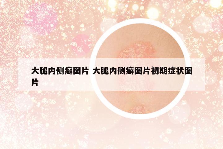 大腿內(nèi)側(cè)癬圖片 大腿內(nèi)側(cè)癬圖片初期癥狀圖片