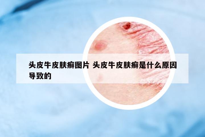 頭皮牛皮膚癬圖片 頭皮牛皮膚癬是什么原因?qū)е碌?><p> </div>
<div id=