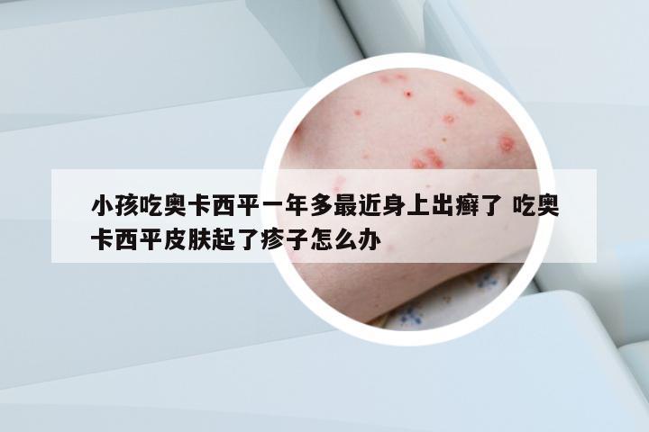 小孩吃奧卡西平一年多最近身上出癬了 吃奧卡西平皮膚起了疹子怎么辦