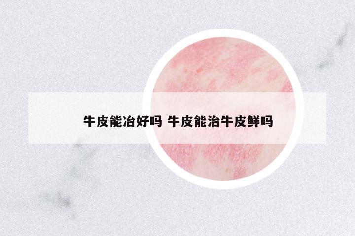 牛皮能冶好嗎 牛皮能治牛皮鮮嗎