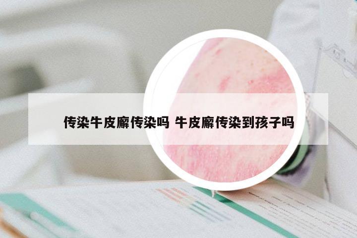 傳染牛皮廨傳染嗎 牛皮廨傳染到孩子嗎