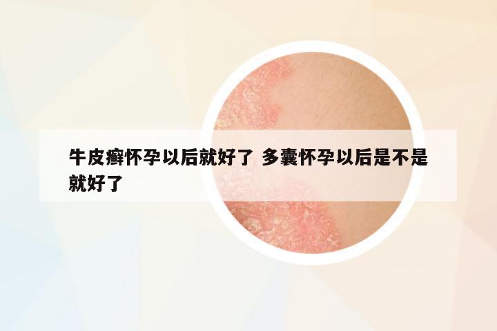 牛皮癬懷孕以后就好了 多囊懷孕以后是不是就好了