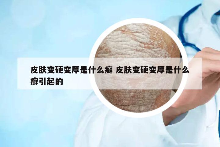 皮膚變硬變厚是什么癬 皮膚變硬變厚是什么癬引起的