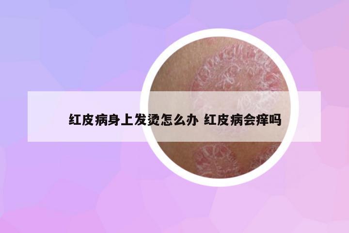 紅皮病身上發(fā)燙怎么辦 紅皮病會(huì)癢嗎