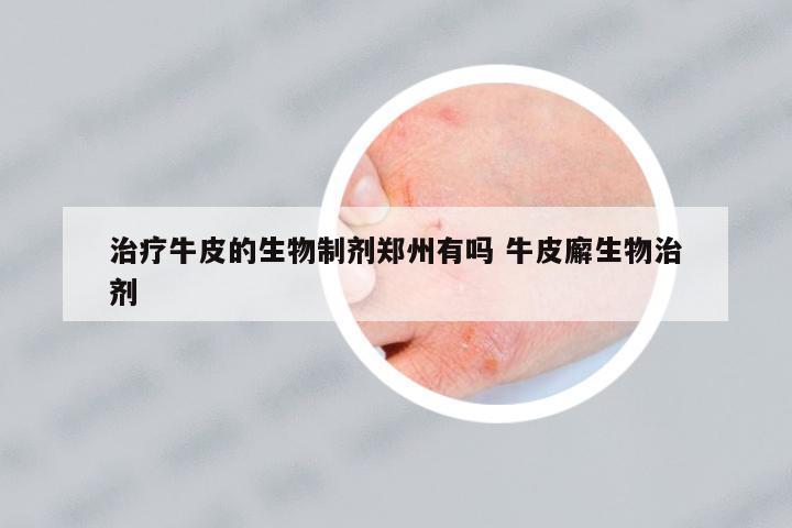 治療牛皮的生物制劑鄭州有嗎 牛皮廨生物治劑