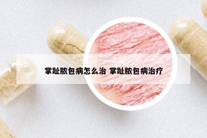 掌趾膿包病怎么治 掌趾膿包病治療