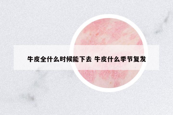 牛皮全什么時候能下去 牛皮什么季節(jié)復(fù)發(fā)