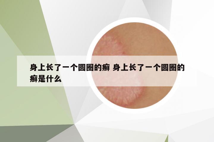 身上長了一個圓圈的癬 身上長了一個圓圈的癬是什么