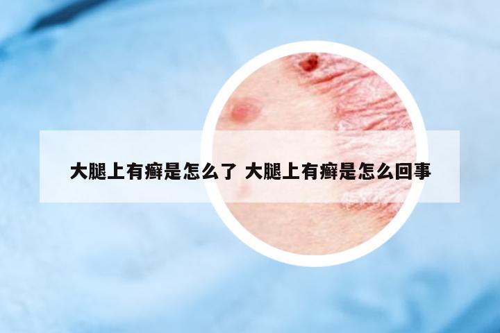 大腿上有癬是怎么了 大腿上有癬是怎么回事