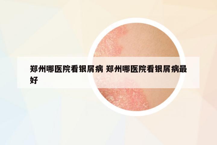 鄭州哪醫(yī)院看銀屑病 鄭州哪醫(yī)院看銀屑病最好