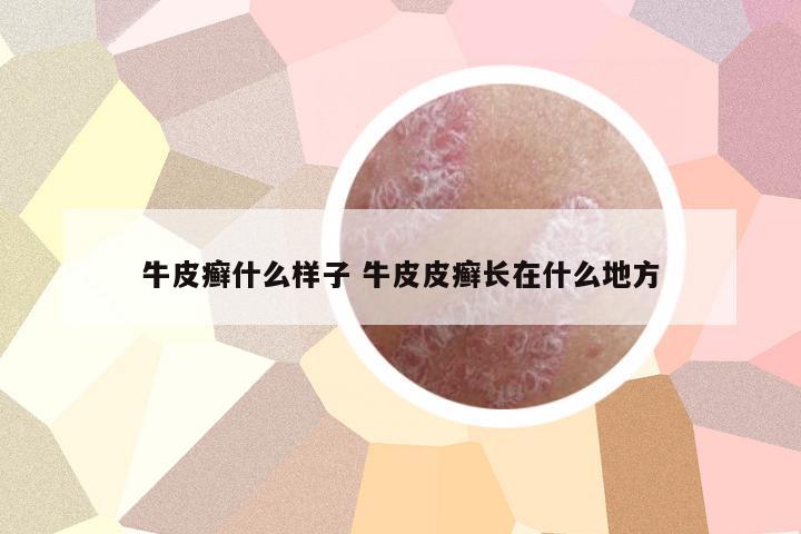 牛皮癬什么樣子 牛皮皮癬長(zhǎng)在什么地方