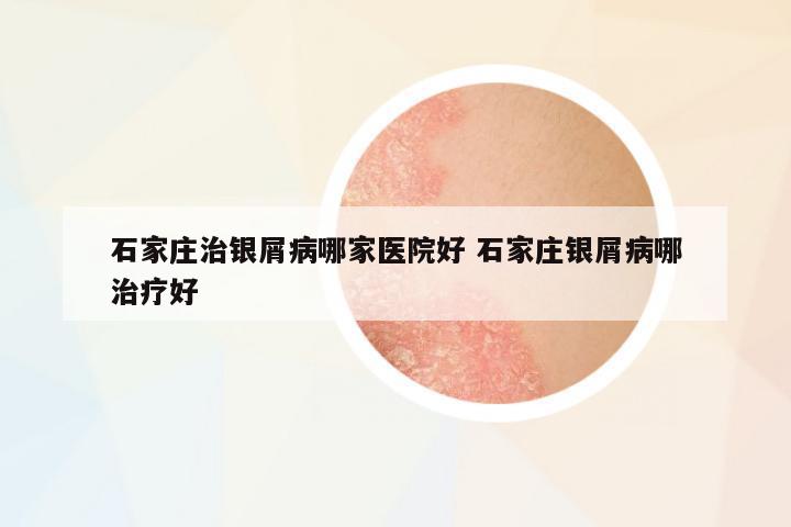 石家莊治銀屑病哪家醫(yī)院好 石家莊銀屑病哪治療好