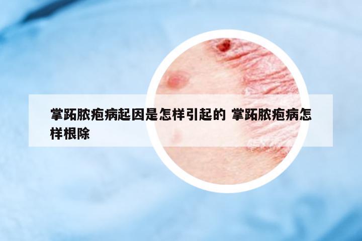 掌跖膿皰病起因是怎樣引起的 掌跖膿皰病怎樣根除