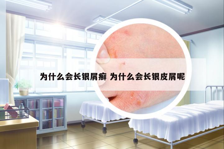 為什么會(huì)長(zhǎng)銀屑癬 為什么會(huì)長(zhǎng)銀皮屑呢