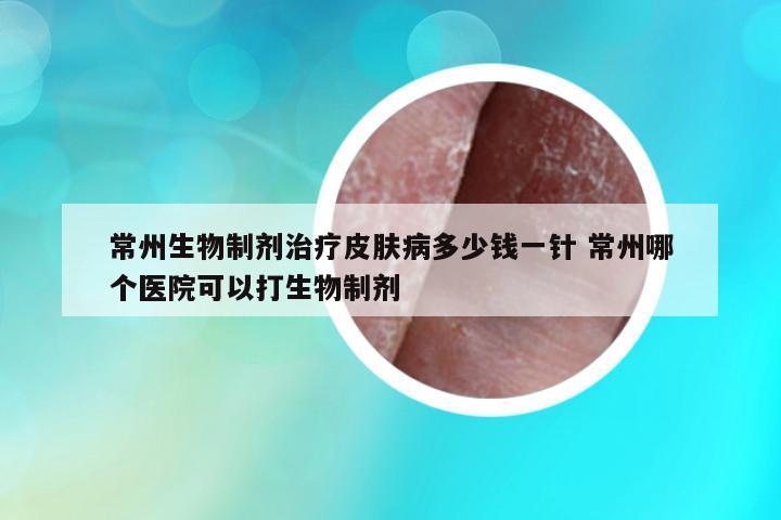 常州生物制劑治療皮膚病多少錢一針 常州哪個(gè)醫(yī)院可以打生物制劑