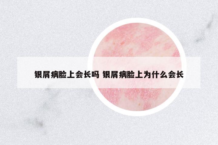 銀屑病臉上會(huì)長嗎 銀屑病臉上為什么會(huì)長