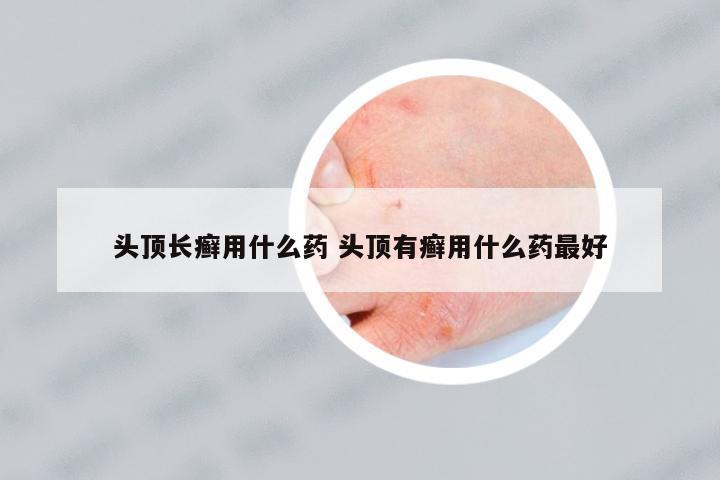 頭頂長(zhǎng)癬用什么藥 頭頂有癬用什么藥最好