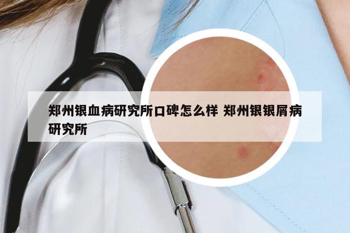 鄭州銀血病研究所口碑怎么樣 鄭州銀銀屑病研究所