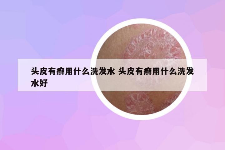 頭皮有癬用什么洗發(fā)水 頭皮有癬用什么洗發(fā)水好