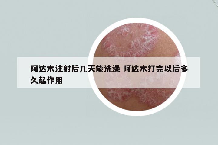 阿達(dá)木注射后幾天能洗澡 阿達(dá)木打完以后多久起作用