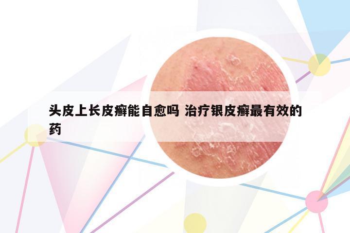頭皮上長(zhǎng)皮癬能自愈嗎 治療銀皮癬最有效的藥