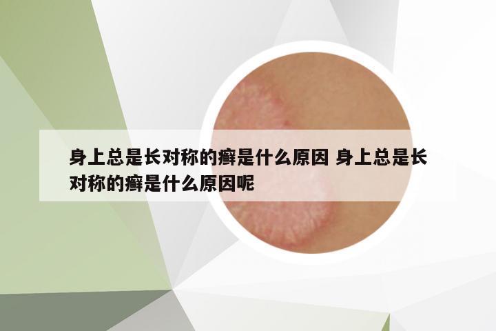 身上總是長(zhǎng)對(duì)稱的癬是什么原因 身上總是長(zhǎng)對(duì)稱的癬是什么原因呢