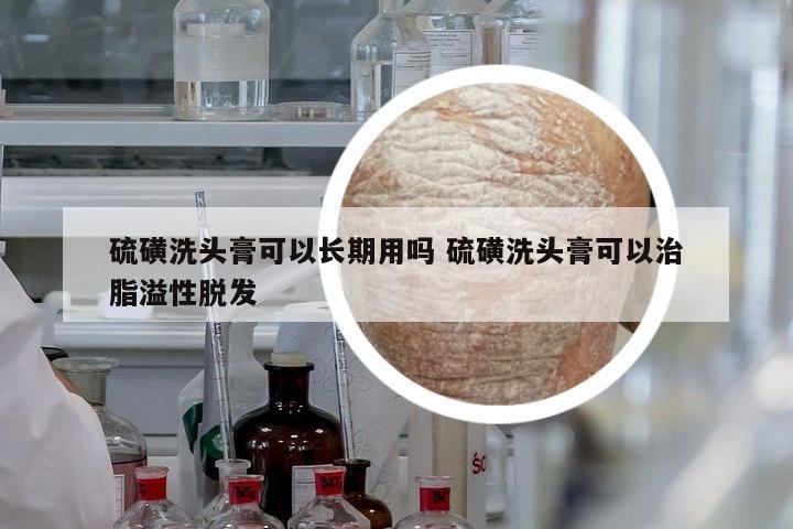 硫磺洗頭膏可以長期用嗎 硫磺洗頭膏可以治脂溢性脫發(fā)