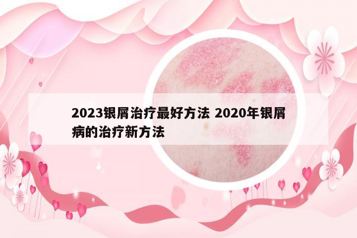 2023銀屑治療最好方法 2020年銀屑病的治療新方法