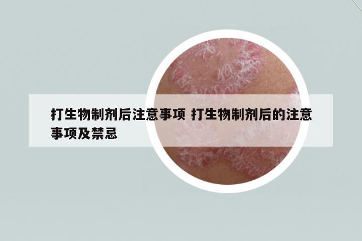 打生物制劑后注意事項 打生物制劑后的注意事項及禁忌