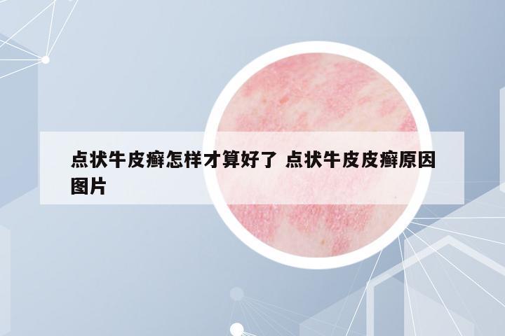 點狀牛皮癬怎樣才算好了 點狀牛皮皮癬原因圖片