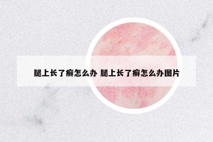 腿上長(zhǎng)了癬怎么辦 腿上長(zhǎng)了癬怎么辦圖片