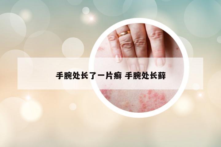 手腕處長(zhǎng)了一片癬 手腕處長(zhǎng)蘚