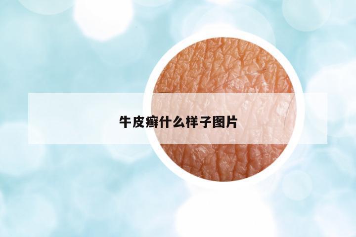 牛皮癬什么樣子圖片