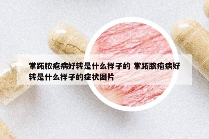 掌跖膿皰病好轉(zhuǎn)是什么樣子的 掌跖膿皰病好轉(zhuǎn)是什么樣子的癥狀圖片