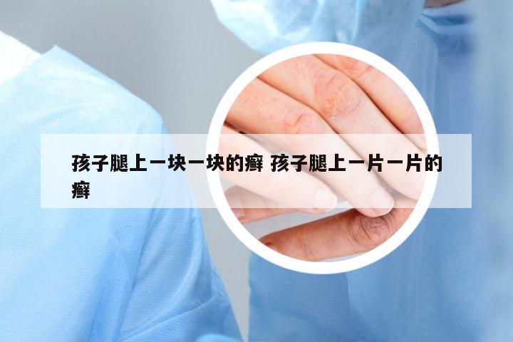 孩子腿上一塊一塊的癬 孩子腿上一片一片的癬