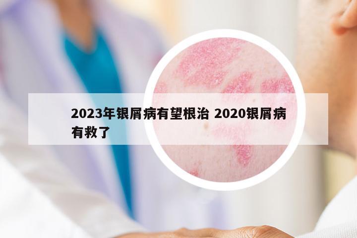 2023年銀屑病有望根治 2020銀屑病有救了