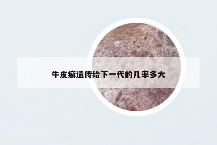 牛皮癬遺傳給下一代的幾率多大