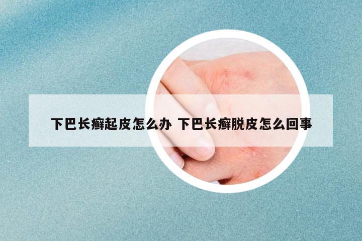 下巴長癬起皮怎么辦 下巴長癬脫皮怎么回事