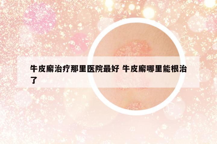 牛皮廨治療那里醫(yī)院最好 牛皮廨哪里能根治了
