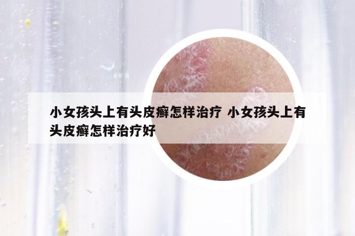 小女孩頭上有頭皮癬怎樣治療 小女孩頭上有頭皮癬怎樣治療好