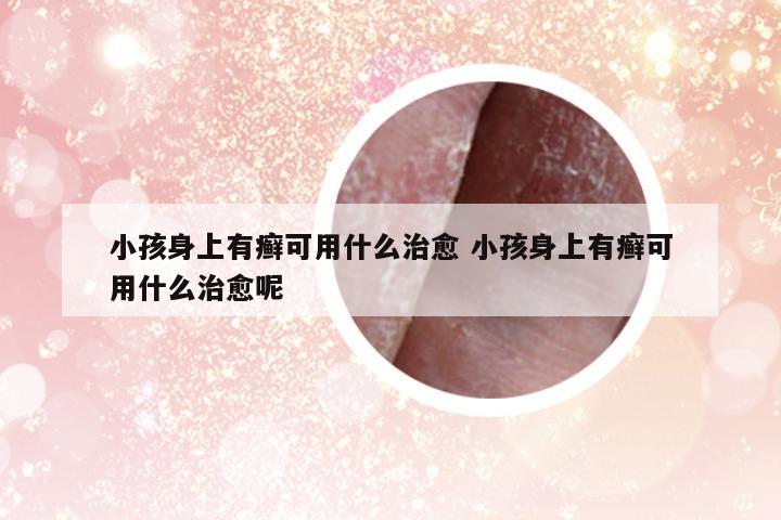 小孩身上有癬可用什么治愈 小孩身上有癬可用什么治愈呢