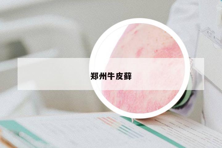鄭州牛皮蘚