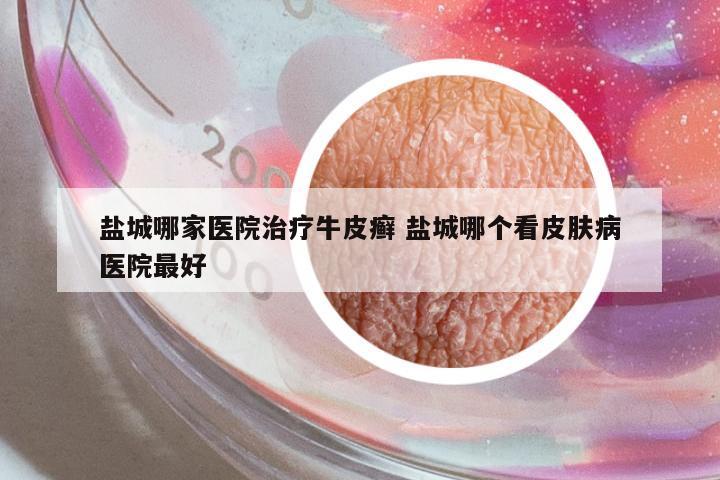 鹽城哪家醫(yī)院治療牛皮癬 鹽城哪個看皮膚病醫(yī)院最好