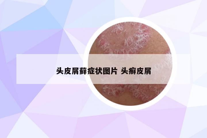 頭皮屑蘚癥狀圖片 頭癬皮屑