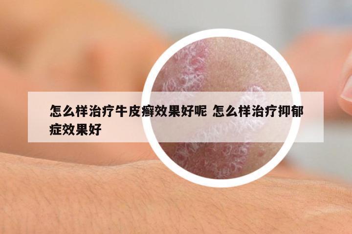 怎么樣治療牛皮癬效果好呢 怎么樣治療抑郁癥效果好