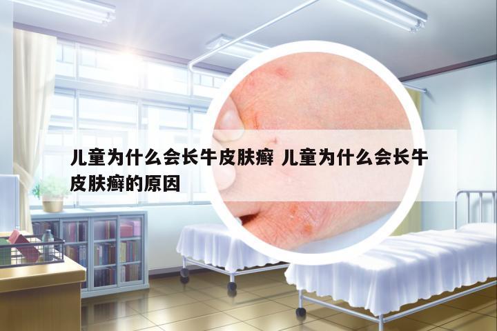 兒童為什么會長牛皮膚癬 兒童為什么會長牛皮膚癬的原因