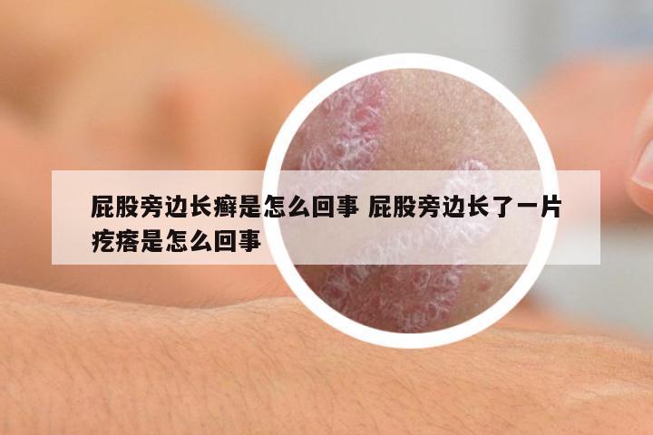 屁股旁邊長(zhǎng)癬是怎么回事 屁股旁邊長(zhǎng)了一片疙瘩是怎么回事