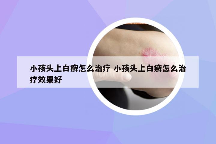 小孩頭上白癬怎么治療 小孩頭上白癬怎么治療效果好