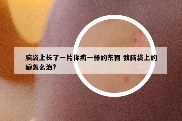 腦袋上長(zhǎng)了一片像癬一樣的東西 我腦袋上的癬怎么治?