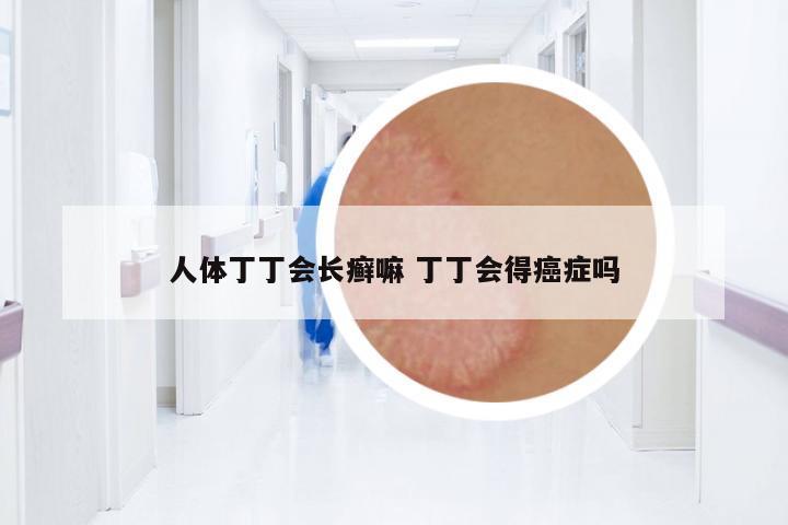 人體丁丁會(huì)長(zhǎng)癬嘛 丁丁會(huì)得癌癥嗎
